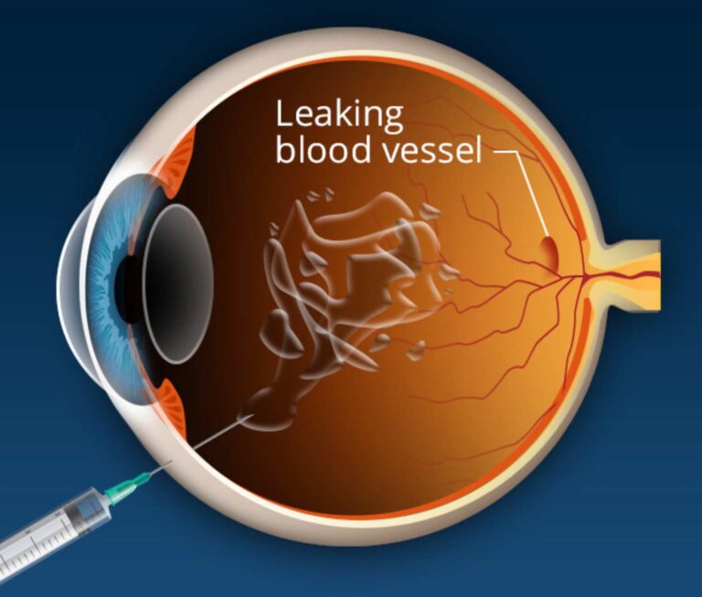 vitreous injection, تزریق داخل چشمی, دکتر محمد ناصری بینایی