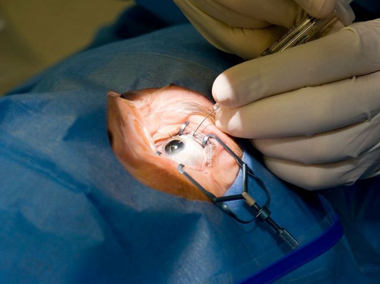 cataract, اب مروارید, دکتر محمد ناصری چشم