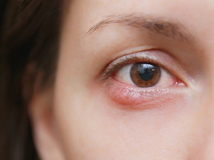 chalazion, شالازیون , دکتر محمد ناصری چشم