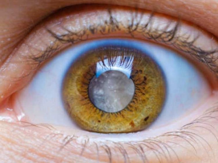 glaucoma, گلوکوم, محمد ناصری چشم